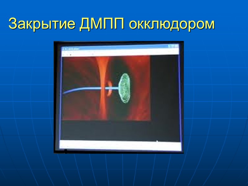 Закрытие ДМПП окклюдором